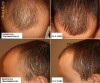 Tratament impotriva caderii parului, cheliei, alopeciei avansate